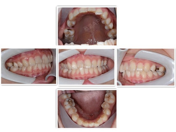 牙齿正确咬合侧面图片