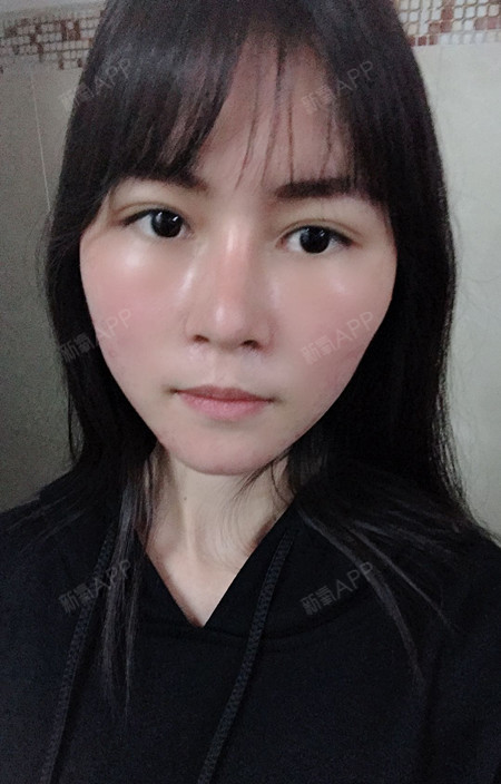 肋骨隆鼻60天广州整形广州艺美李闯医生