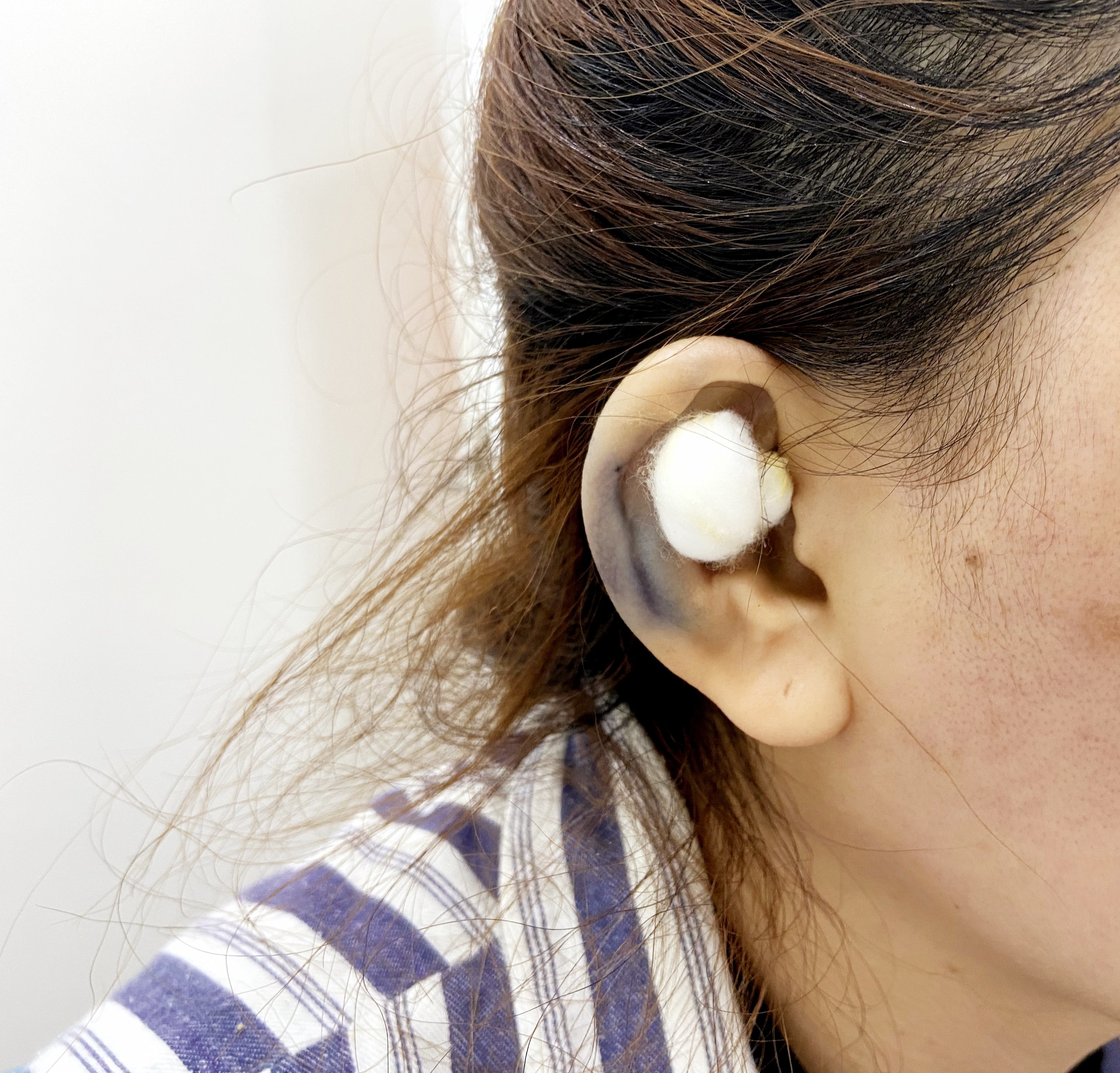 医院:【成都渼淳玉颜】手术项目:贴发耳矫正做完手术_圈子-新氧美容