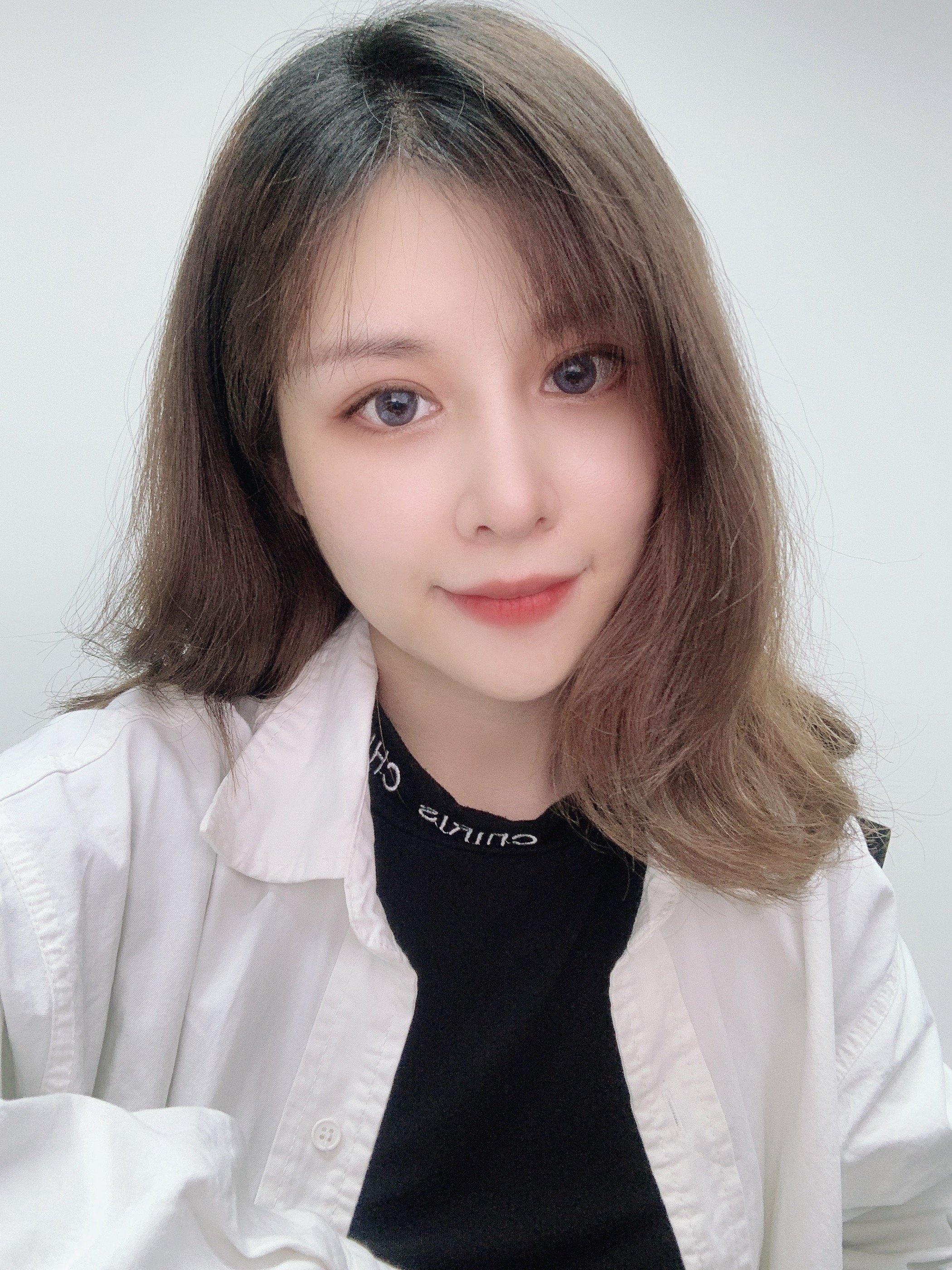 求美者分享:(内附素颜照)双眼皮没疤痕增生还自然