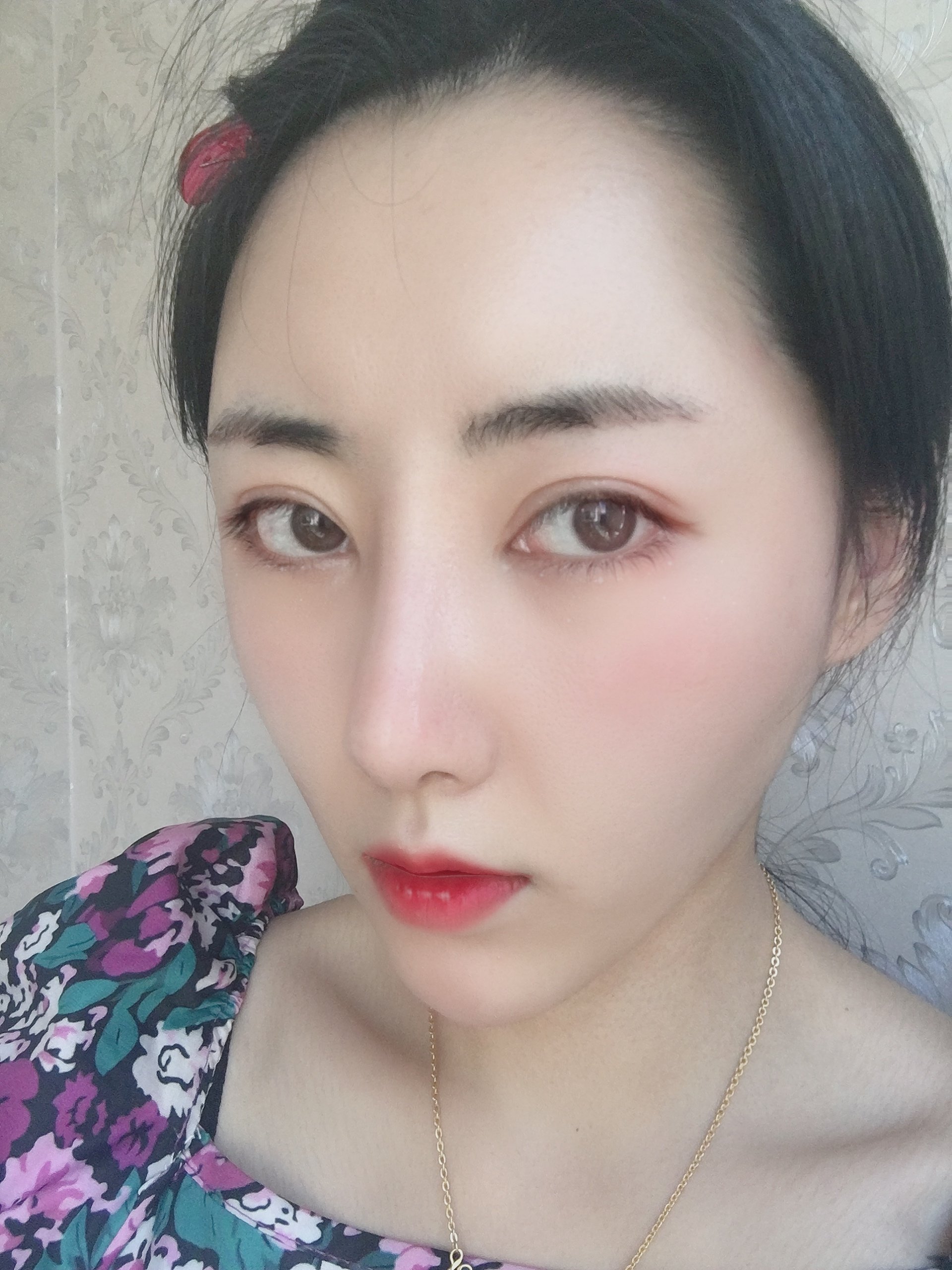 铭医日系轻氧鼻术后34天