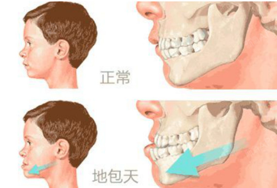 骨性牙性?戴_圈子-新氧美容整形