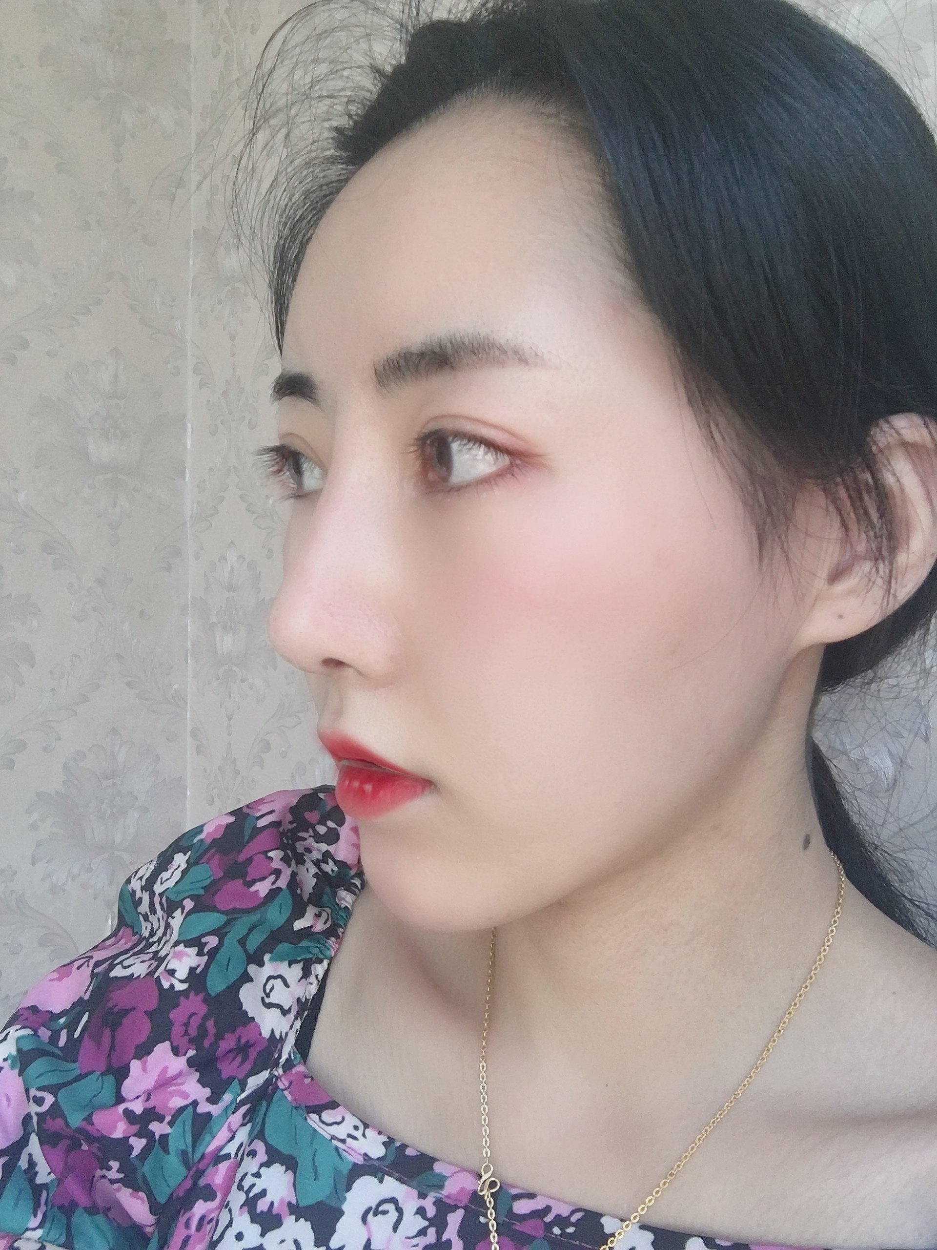 铭医日系轻氧鼻术后34天