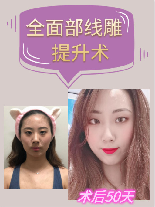 全面部线雕提升术 术后50天不知不觉已经50天了,_圈子-新氧美容整形