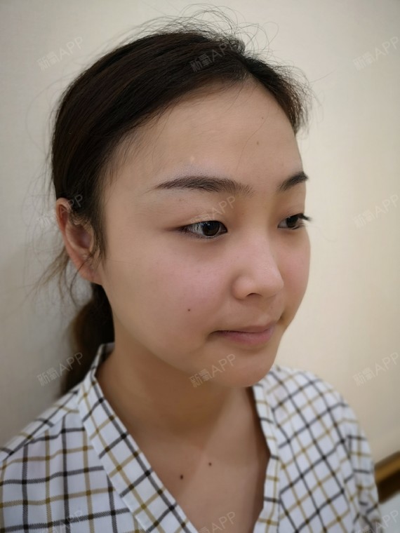 前】大家看看我这明显的蒜头鼻,我想我也不用多描_圈子-新氧美容整形