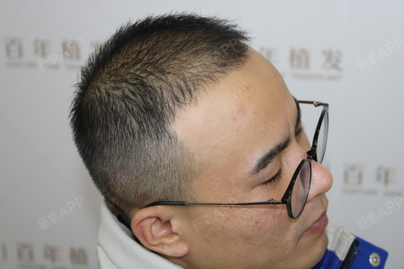 合肥华海植发(合肥头发植发的一般价格是多少)