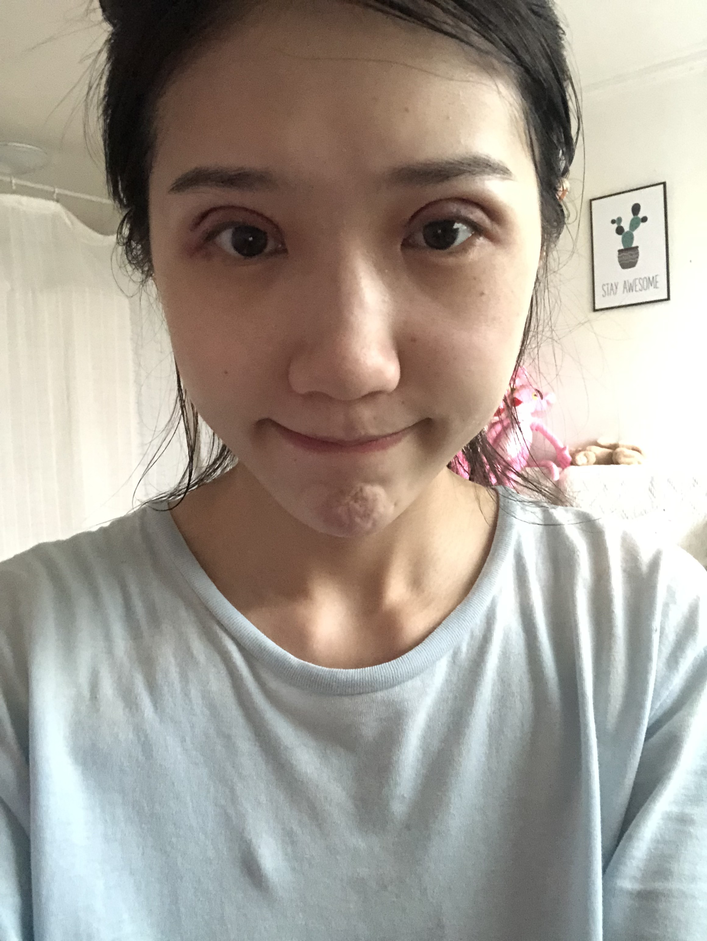新氧小白前来报到了哦,只是才做完双眼皮第二天的样子_圈子-新氧美容