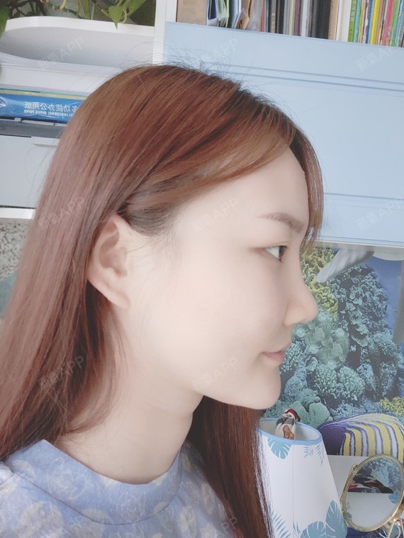 【吉林铭医整形】日系轻氧鼻-术后32天