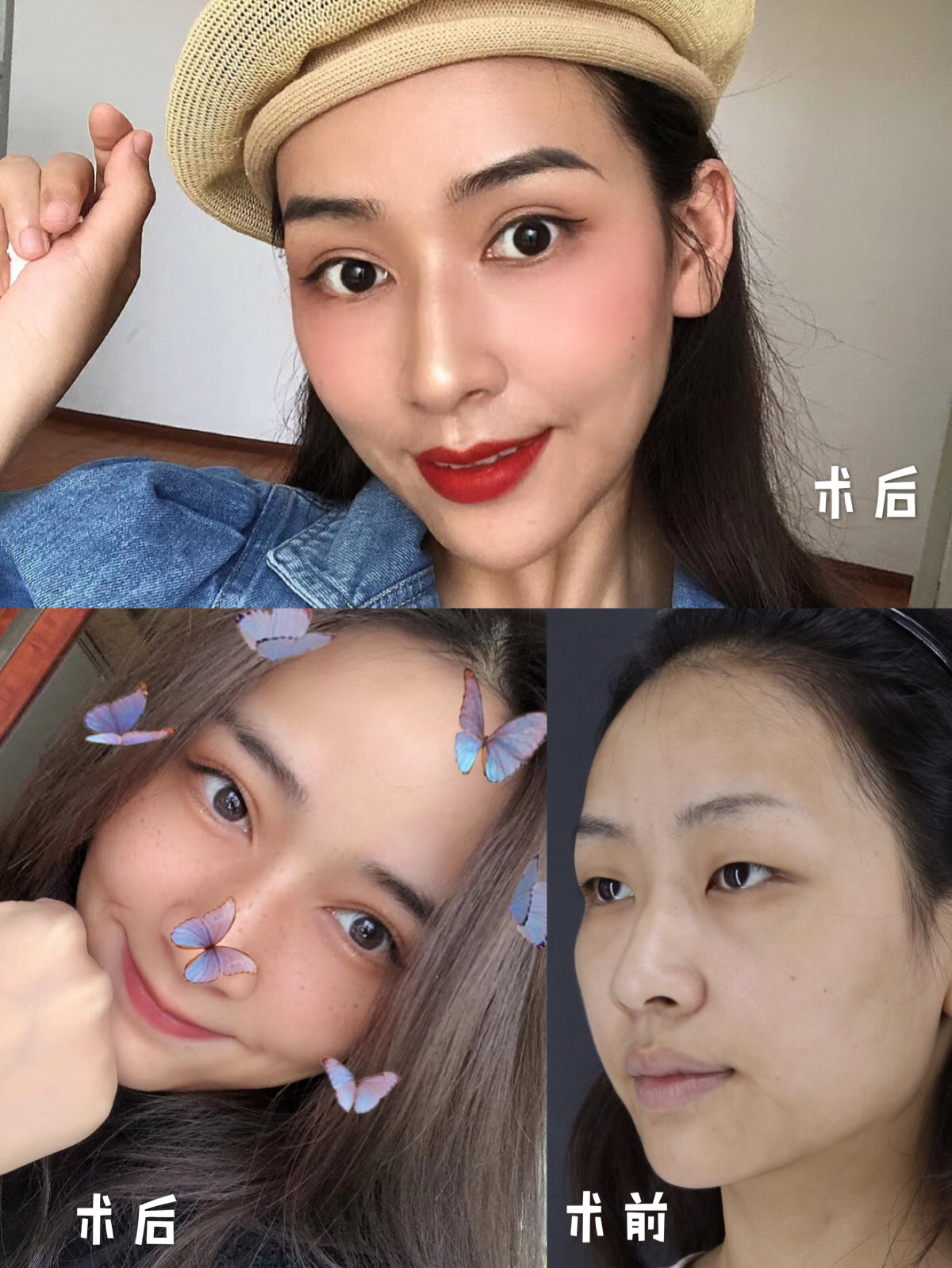 【医生诊断书】死鱼眼是如何变成撩人双眼皮的!