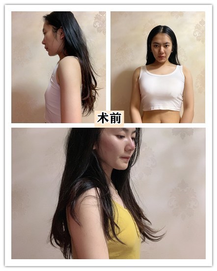 想要这样同款胸的姑娘可能是想拥有大一点的胸,而胸部的大小与假体的