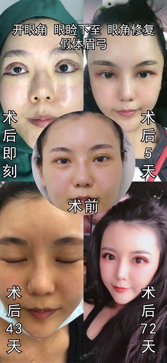 功课贴修复内眼角有的医生说眼角回缩术有的是包眼角一样吗