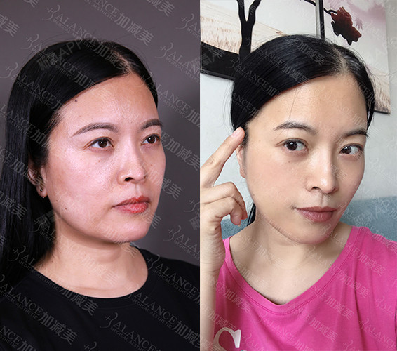 v美减龄—v6定格青春术术后15天