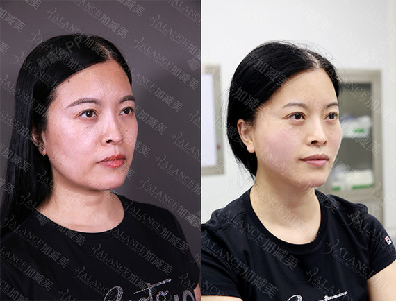 v美减龄—v3定格青春术术后0天