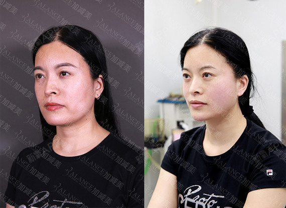 v美减龄—v3定格青春术术后0天