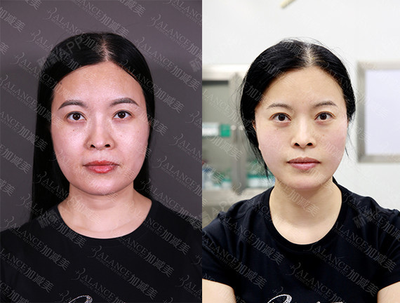 v美减龄—v3定格青春术术后0天