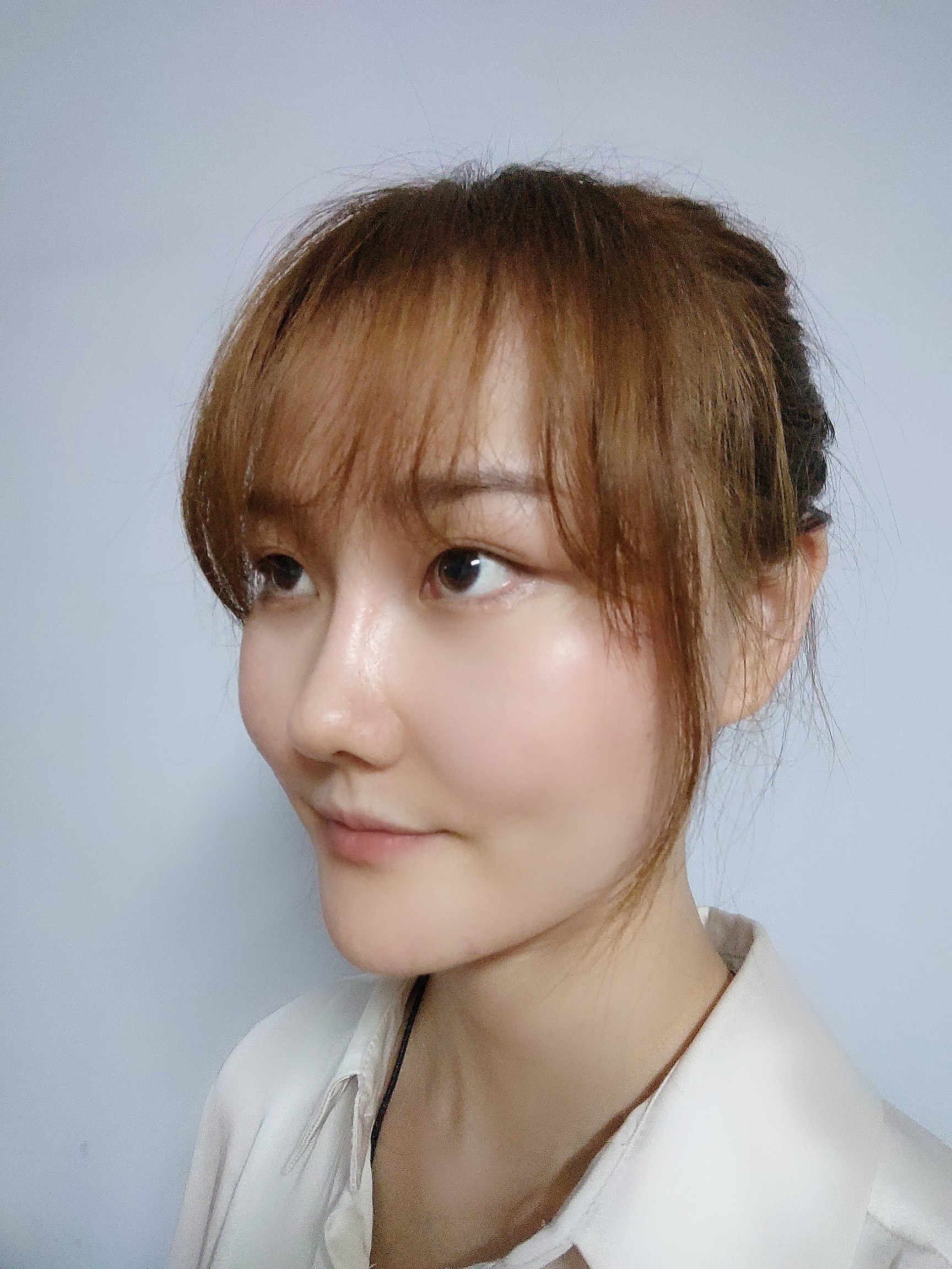 【吉林铭医整形】日系轻氧鼻-术后49天