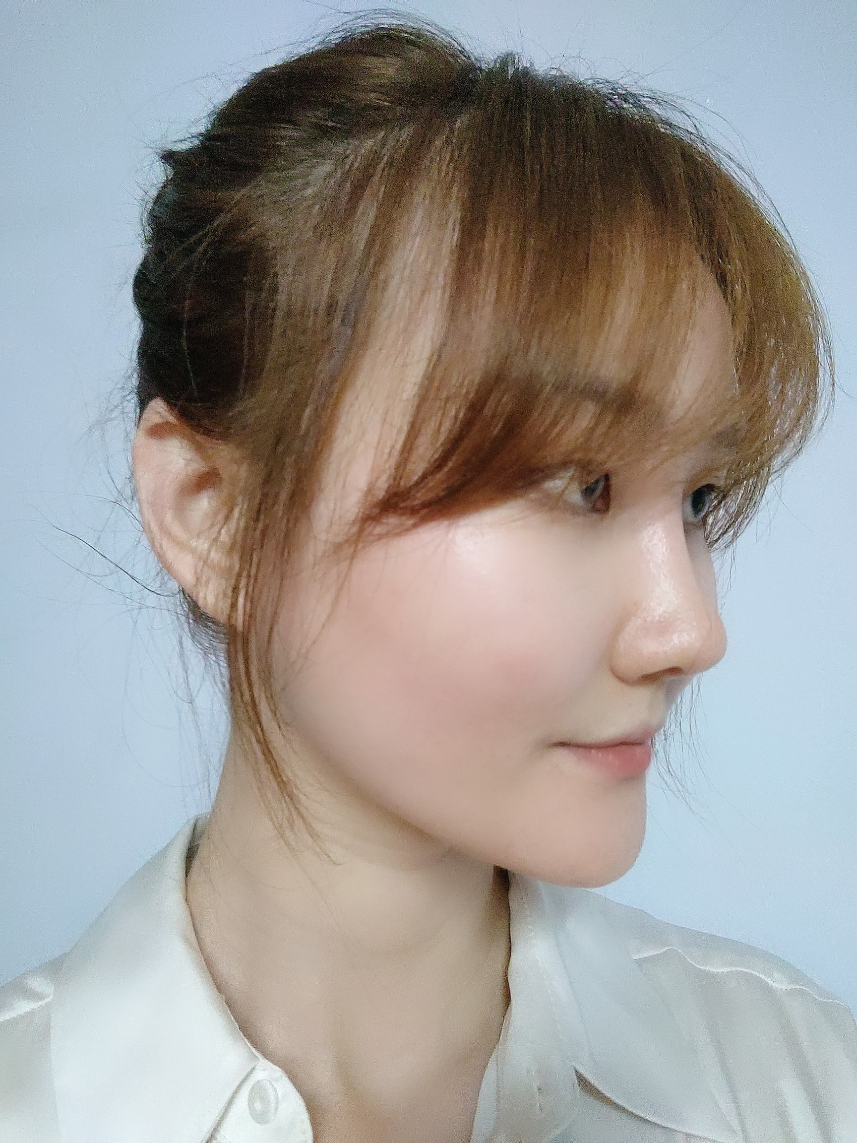 吉林铭医整形日系轻氧鼻术后49天