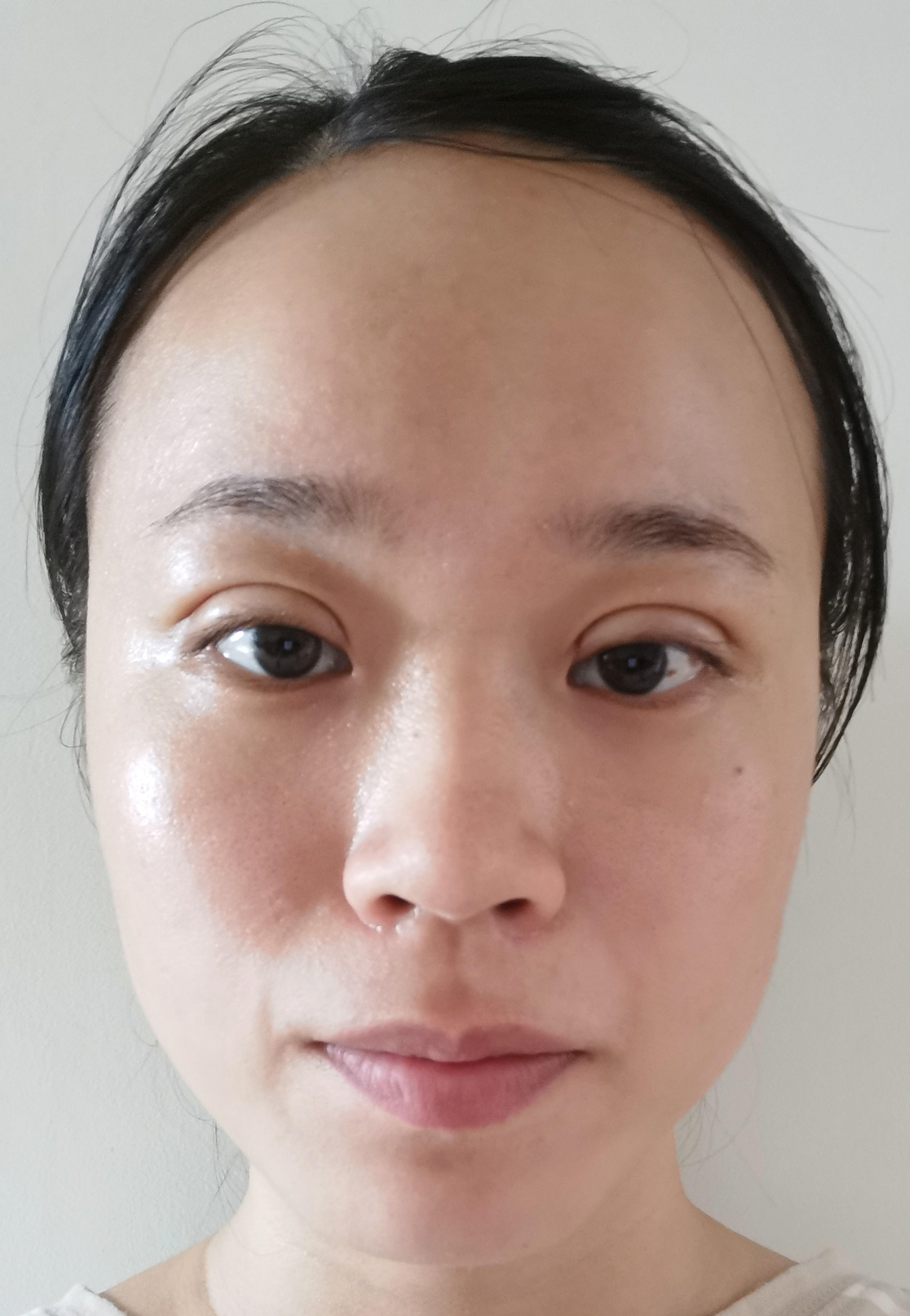 这是我做完双眼皮的第5天的时候,眼睛红的已经消了,_圈子-新氧美容