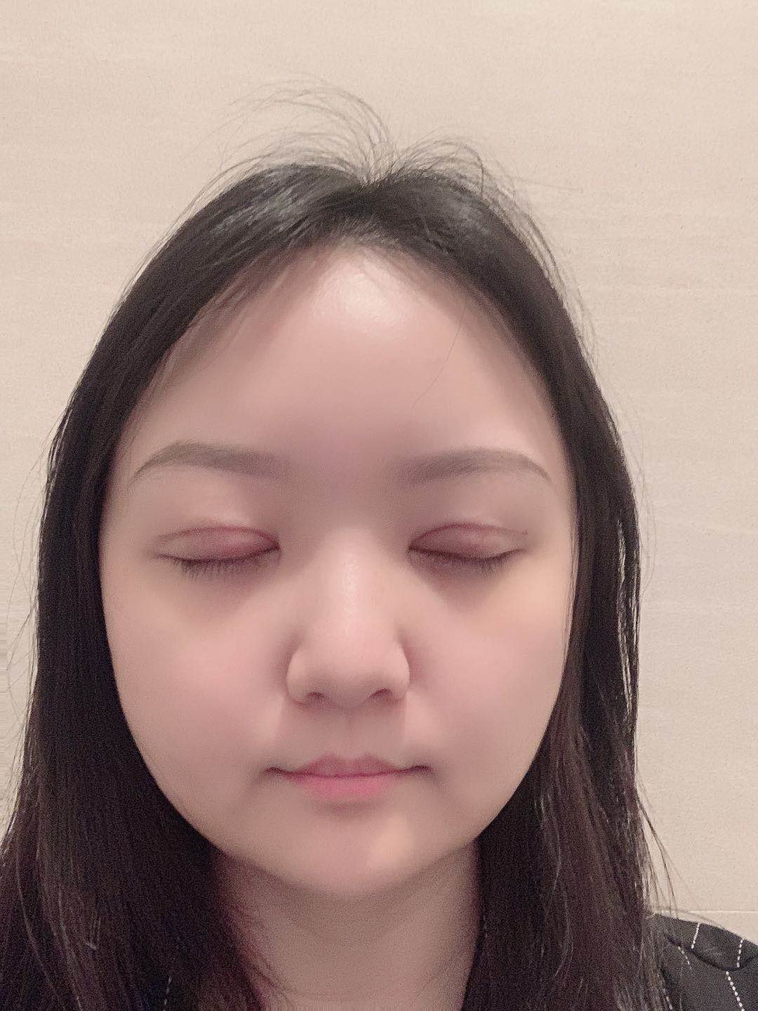 【求美者分享:双眼皮修复术后第四天】内附恢复过程图