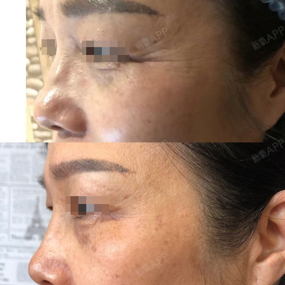 水剥离祛除眼角纹,还你美丽自信