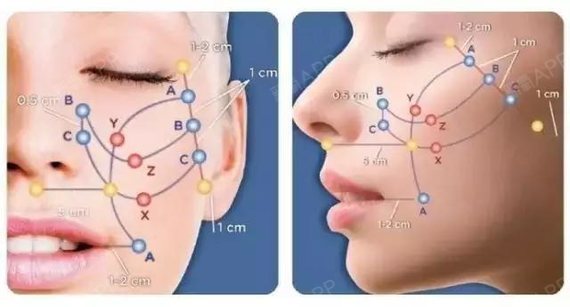 线雕多长时间效果最好,有人说脸部线雕后有一边有凹?