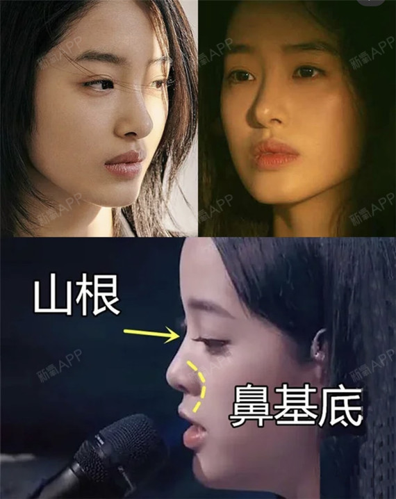 后缩导致凸嘴,无美人线,可以通过注射或假体垫下巴,颏前移手术改善