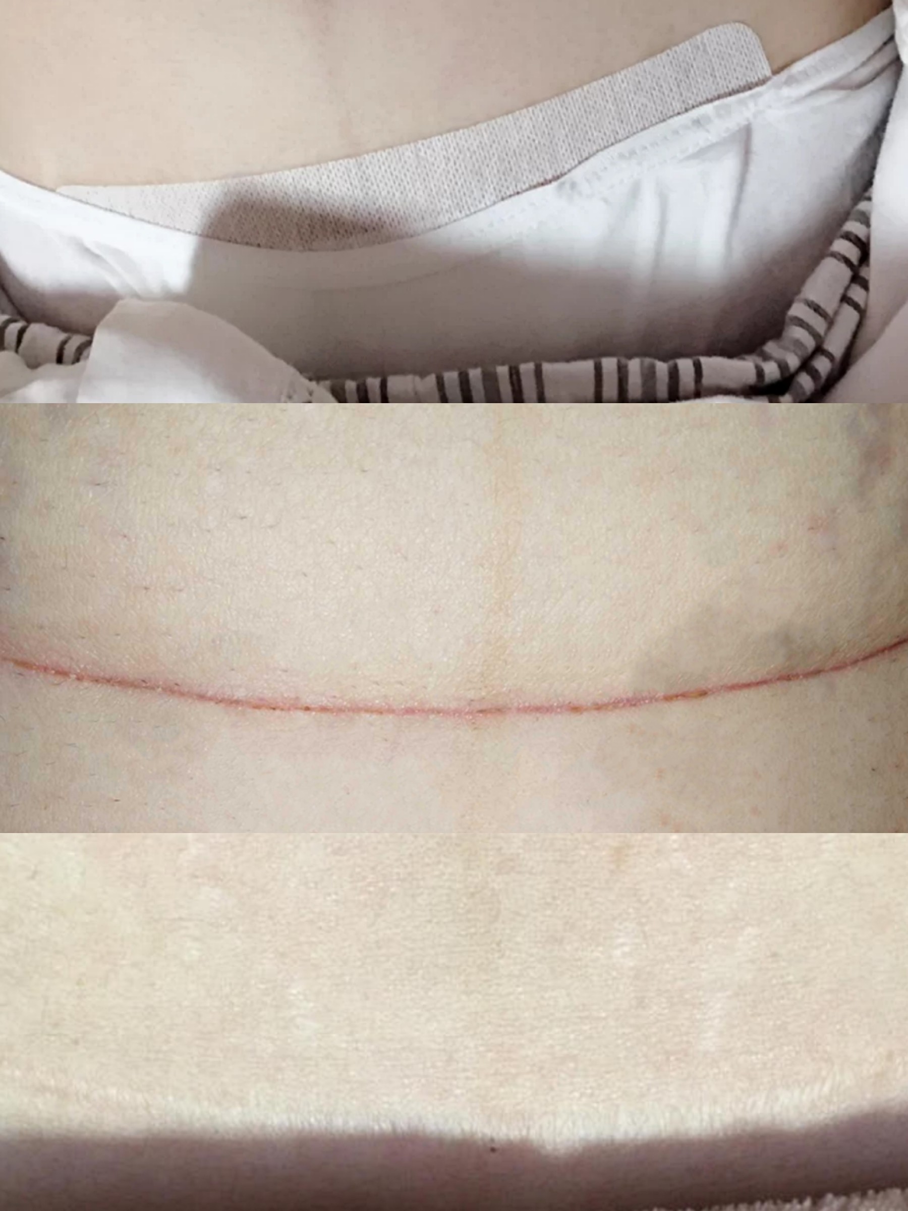 剖腹产术后护理经验真的没有留疤