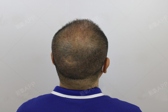 种植头顶加密项目 术后第一个月【常州百年植发】