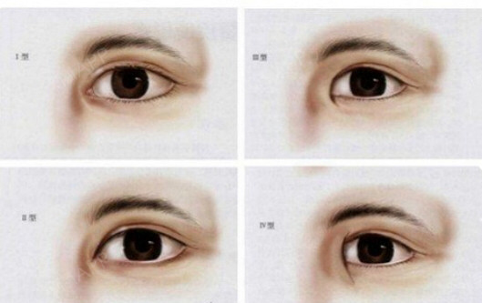 1,眼间距过远可以考虑开眼角;2,眼头内眦赘皮牵扯眼睛形态;3,泪阜毫无
