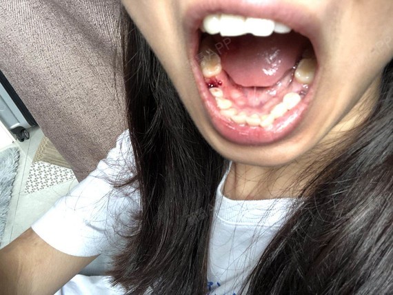 今天来拔右侧的牙了,距离左侧拔完已经十天了,医生说_圈子-新氧美容