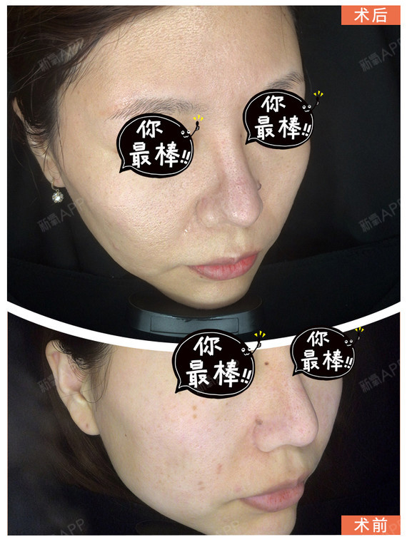 超皮秒反黑:别慌,小场面 超皮秒祛斑后出现色素沉着_圈子-新氧美容