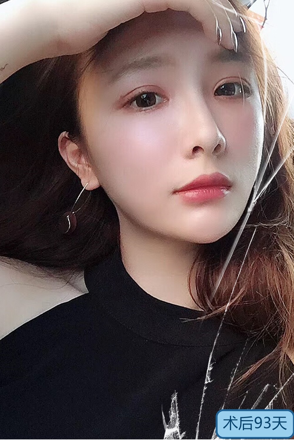 【鼻部多项】气质直翘鼻,让人看了一眼就很心动!