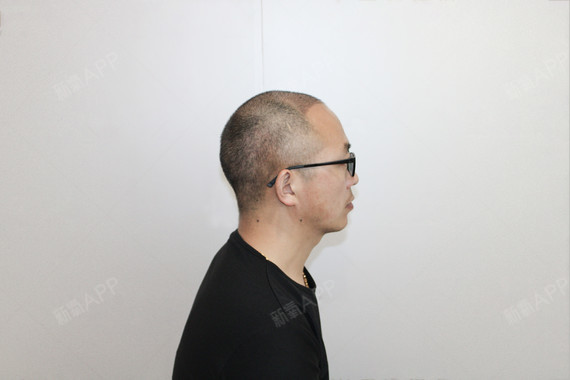 关于无锡植发首来百年植发的信息