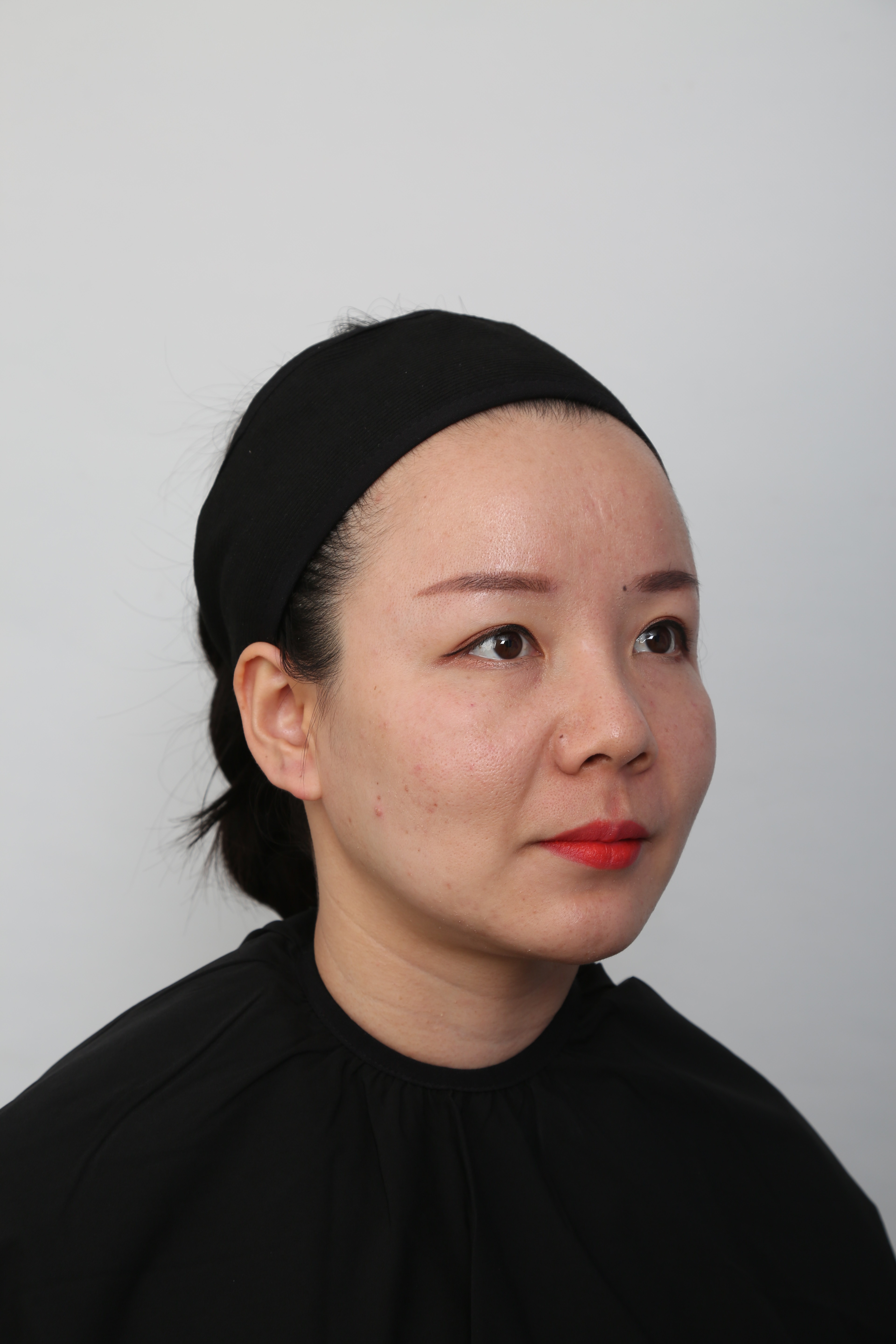 玻尿酸注射/术后7天