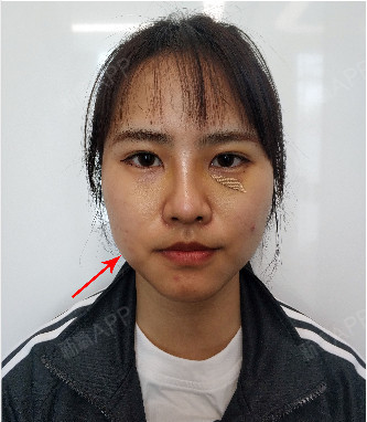 颊脂垫是什么王医生带你了解其中的奥秘