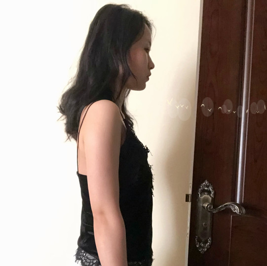 我隆胸的原因:是因为我生过宝宝,胸部下垂了,相信生_圈子-新氧美容