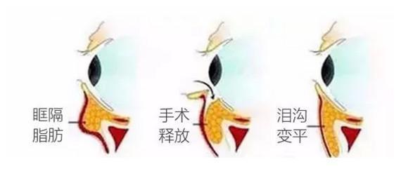 什么是眶隔脂肪释放术?