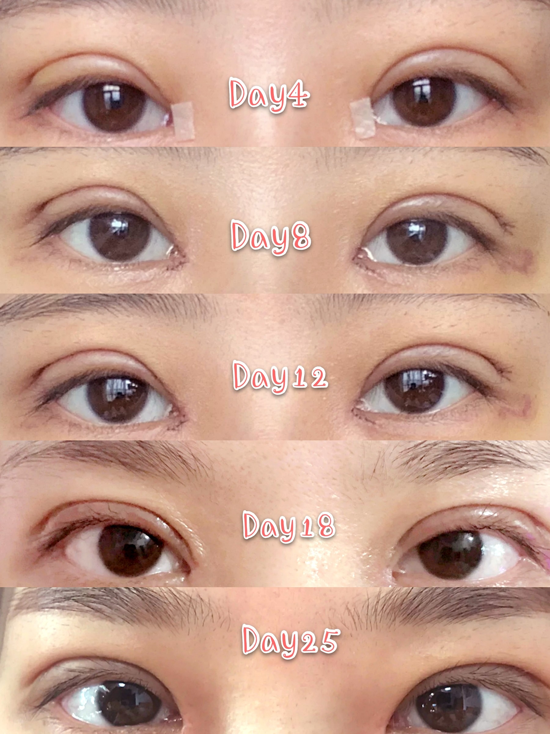 花了2万做的全切双眼皮,一点都不亏