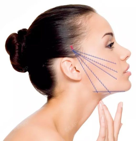 来一次大v线提升多久有效果,考虑埋大v线有副作用吗