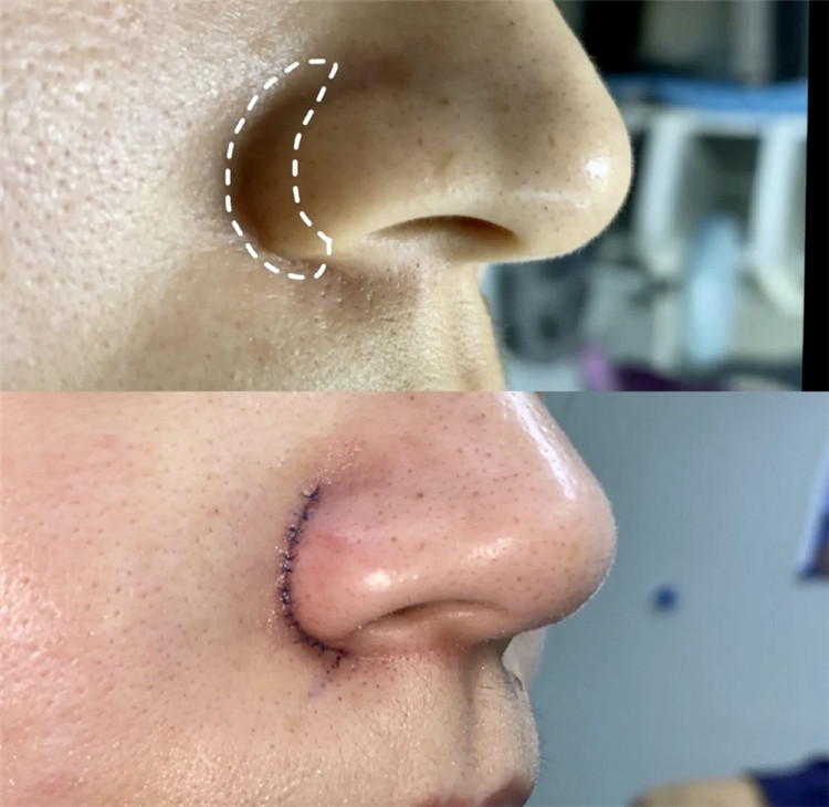 缩鼻翼为什么建议做外切