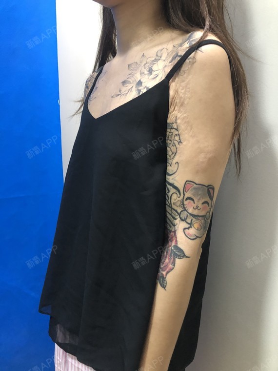 【假体隆胸当天】【广州艺美李闯院长】我一直都是朋友_圈子-新氧美容