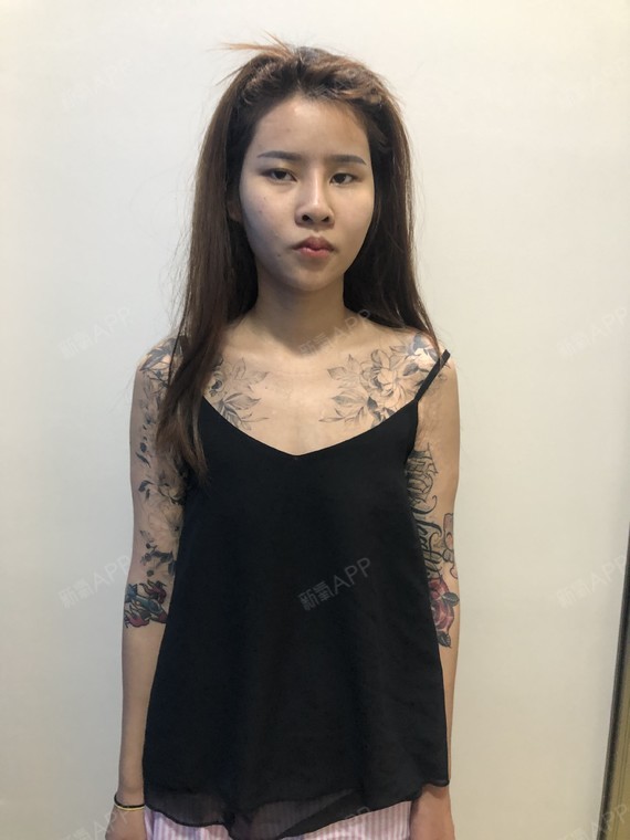 【假体隆胸当天】【广州艺美李闯院长】我一直都是朋友_圈子-新氧美容