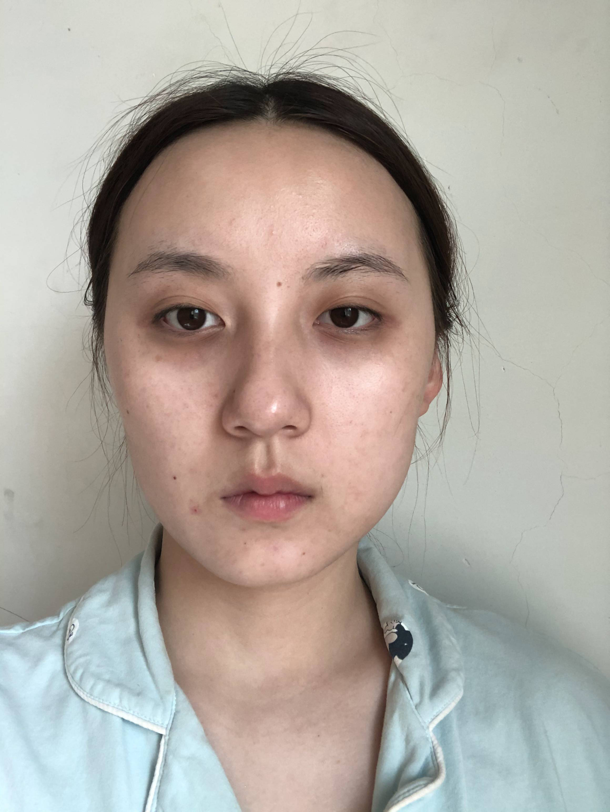 患者自述:长眼袋已经很多年了,原来只是一丢丢眼袋的_圈子-新氧美容