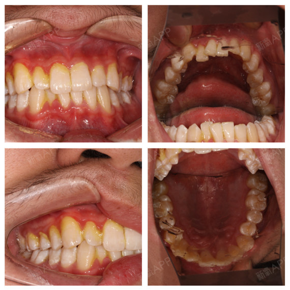我的牙齿问题主要就是下排牙不齐,有些下兜齿,牙齿问_圈子-新氧美容