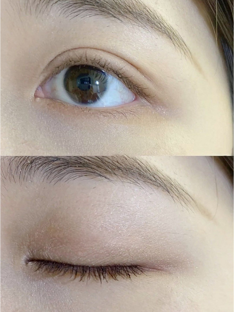 全切双眼皮7mm宛如天生模样