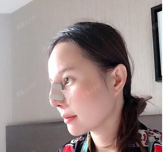 手术之前的我鼻翼部分有些向外扩的痕迹,其实我鼻孔还_圈子-新氧美容