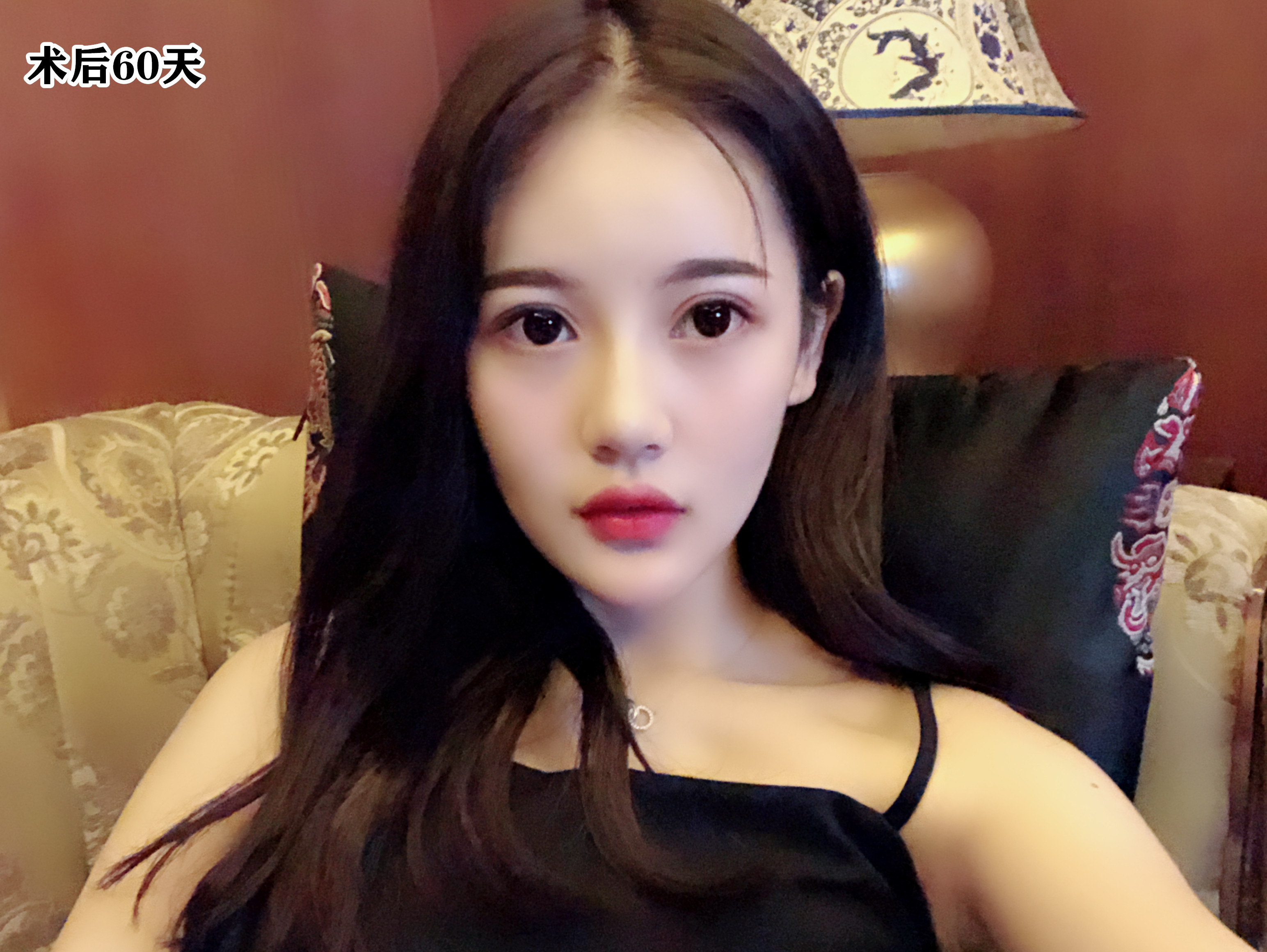 【眼部多项案例分享】来自小姐姐做完双眼皮的自述