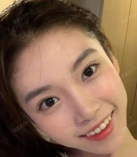 不懂这些,不要轻易割双眼皮