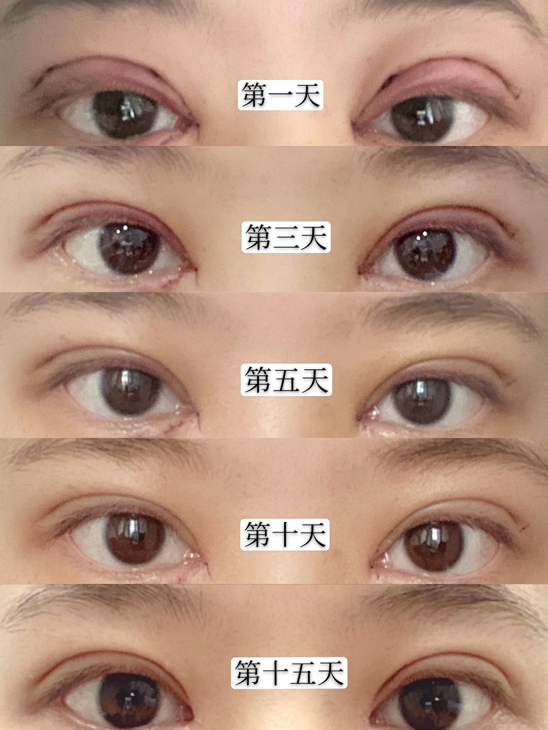 做的双眼皮能自然到什么程度