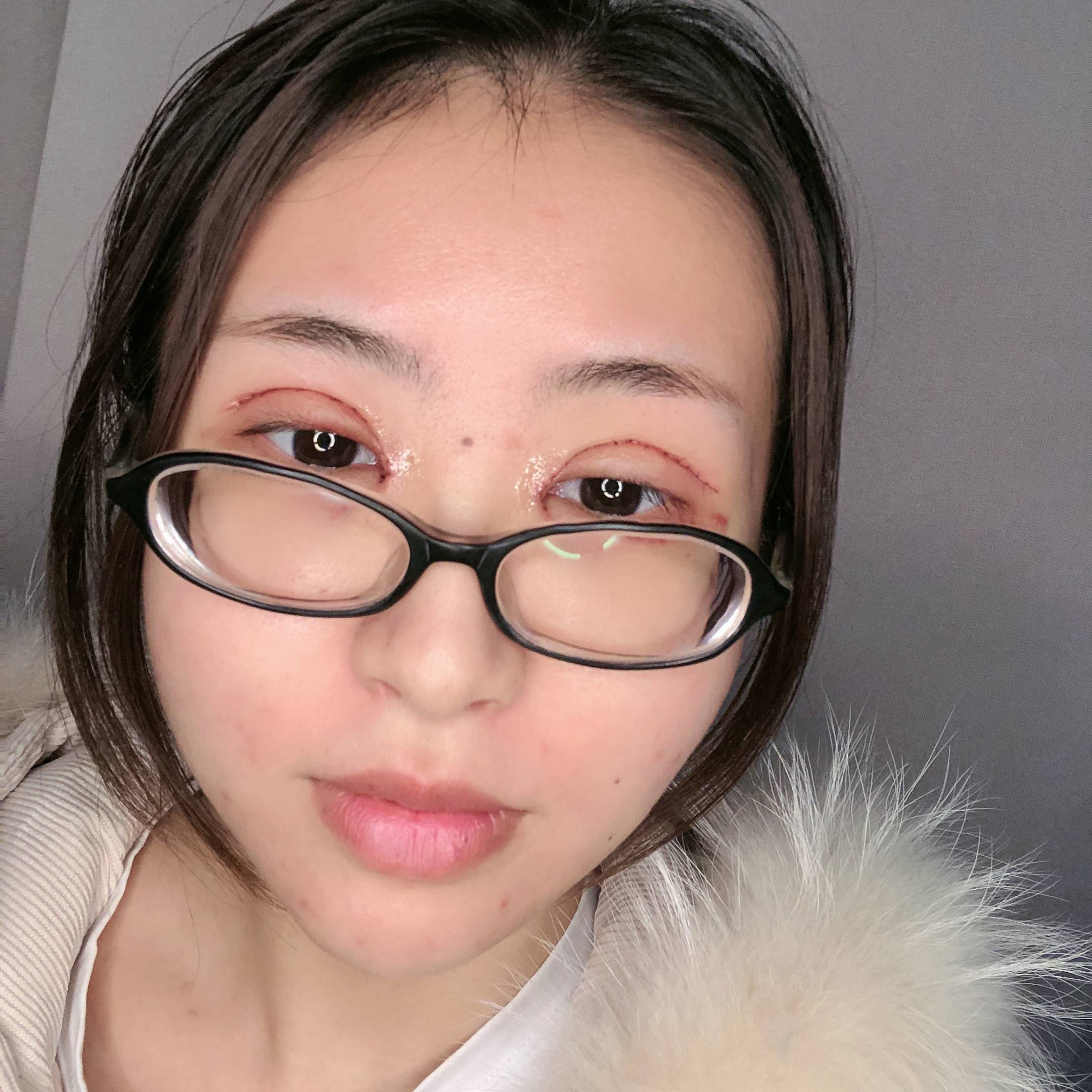 今天是我的双眼皮术后第三天了,第一次看到那么肿的自_圈子-新氧美容